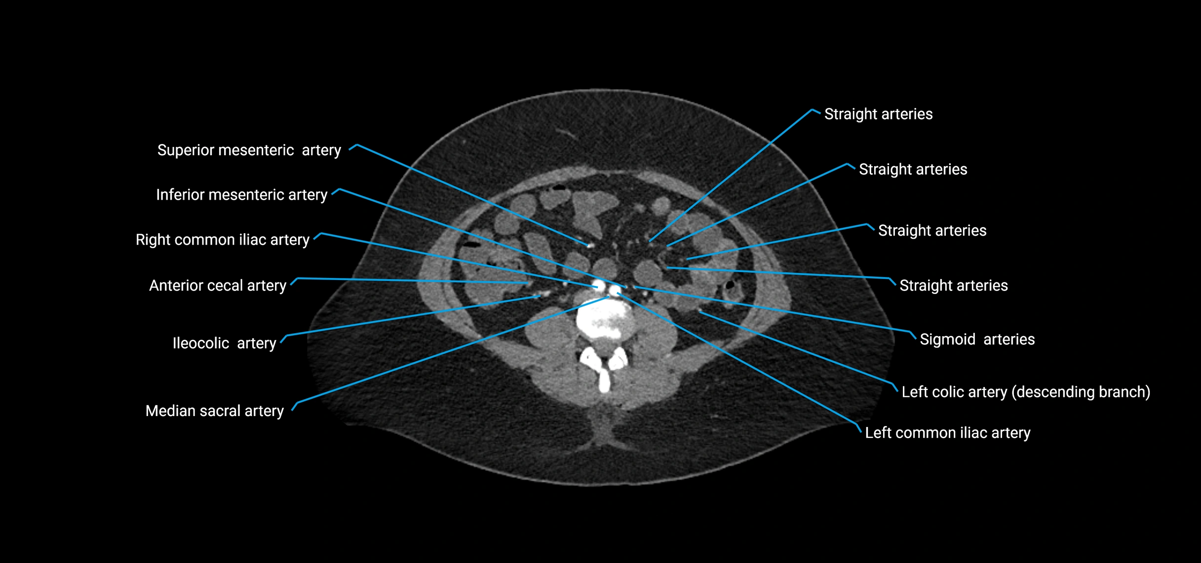 CTA abdomen axial cross sectional anatomy labelled image_131 (2).webp